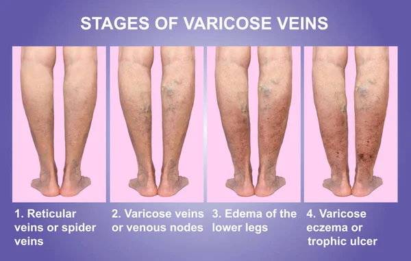 Varicose veins on a female senior leg