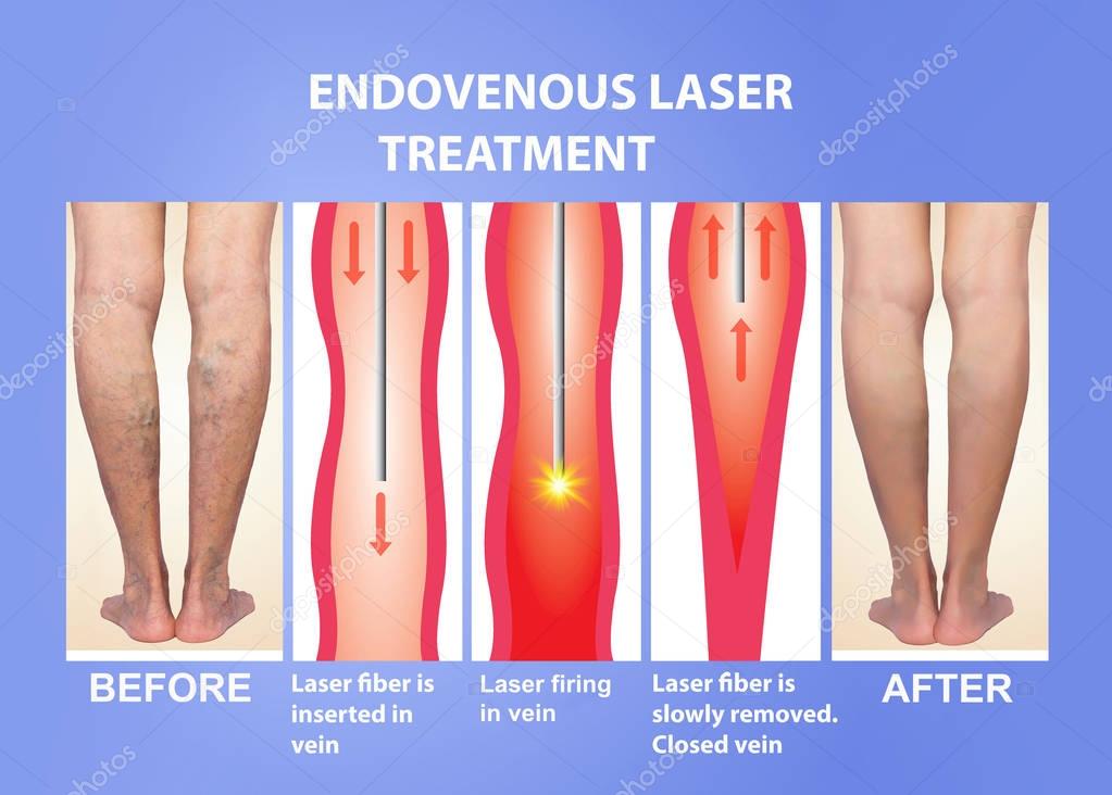 Varicose Veins and laser