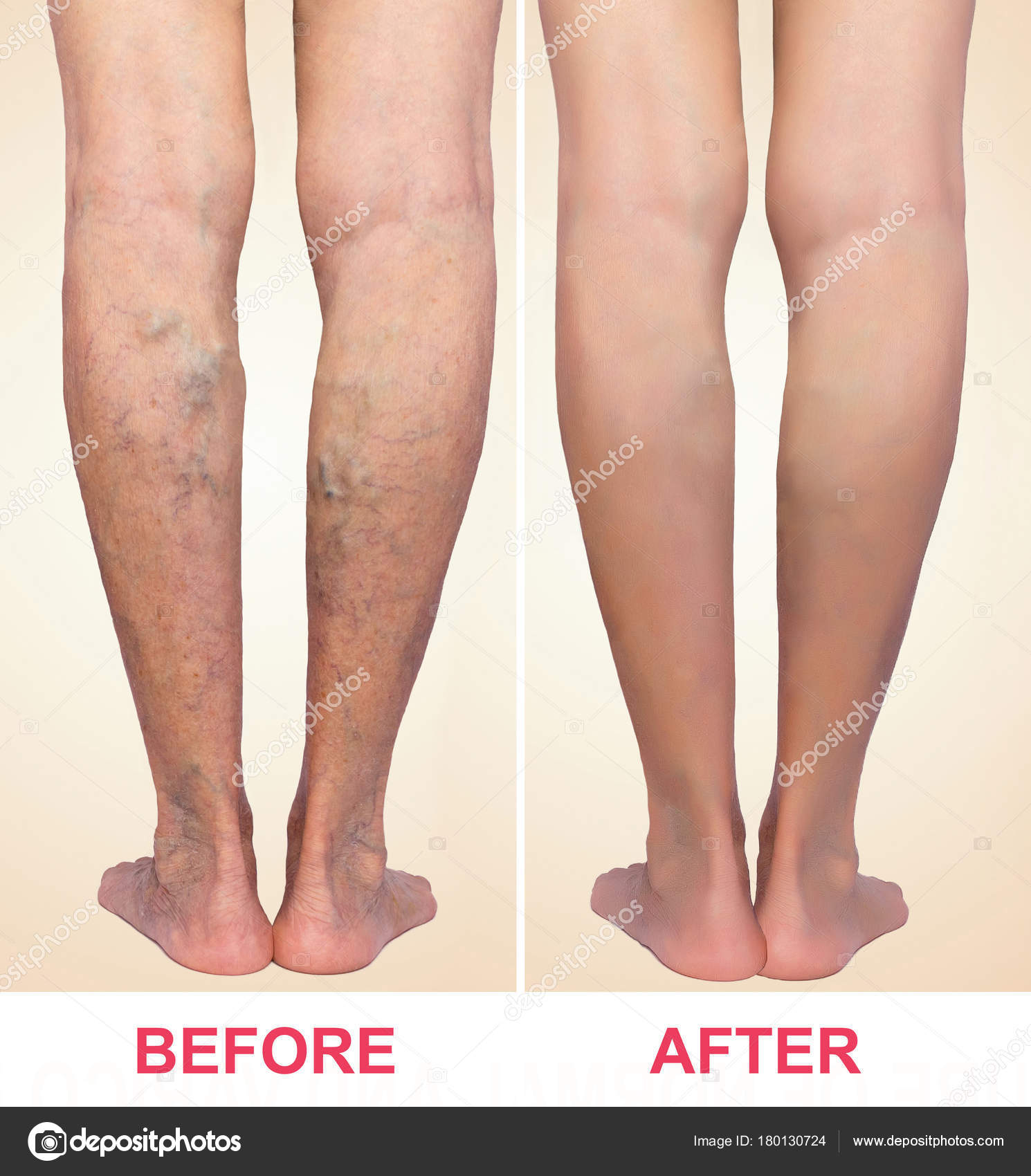varices jambes traitement varices jambes traitement