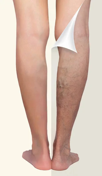 Лечение варикозного расширения до и после. Варикозные вены на ногах . — стоковое фото