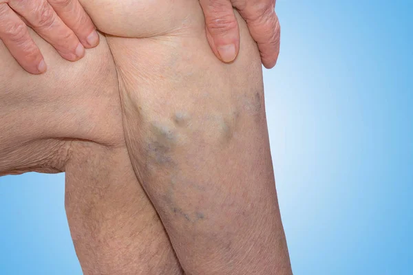 Das Alter Und Die Krankheit Einer Frau Krampfadern Den Beinen — Stockfoto