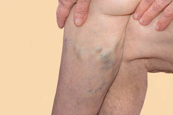 Yaşlı kadın mavi ayak üzerinde varisli damarlar — Stok fotoğraf