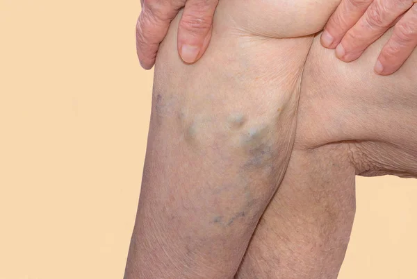 The varicose veins on a legs of old woman on blue