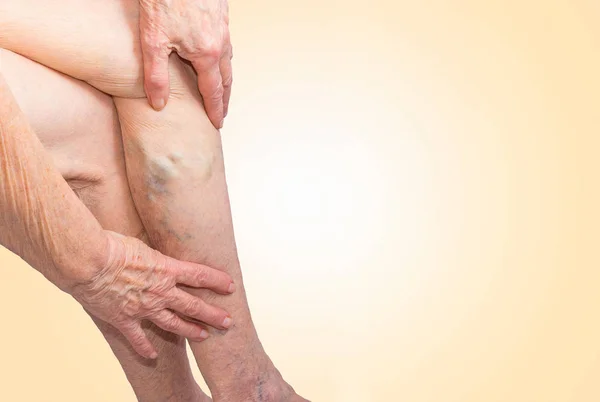 The varicose veins on a legs of old woman on blue — Stock Photo, Image