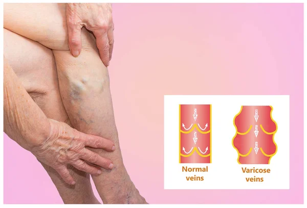 Варикозные вены на старшей ноге женщины — стоковое фото
