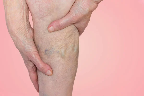 The varicose veins on a legs of old woman on blue — Stock Photo, Image