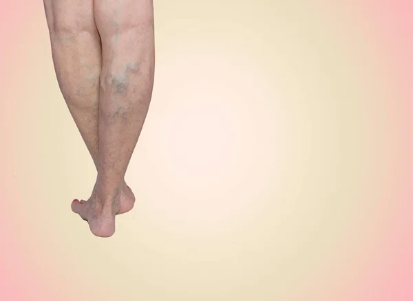Die Krampfadern an den Beinen einer alten Frau auf blau — Stockfoto
