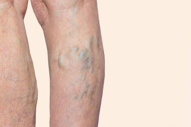 The varicose veins on a legs of old woman on blue clipart