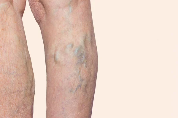 The varicose veins on a legs of old woman on blue — Stock Photo, Image