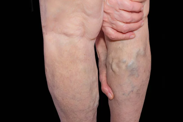 The varicose veins on a legs of old woman on blue — Stock Photo, Image