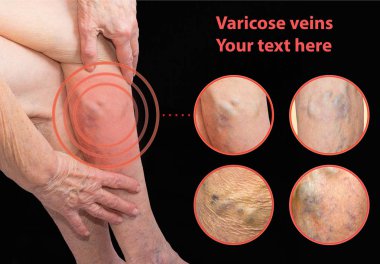 The varicose veins on a legs of old woman on gray clipart