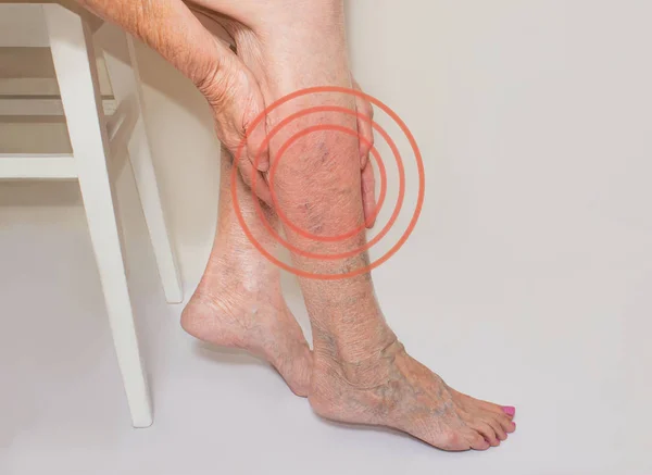 Les varices sur les jambes de la vieille femme sur le gris — Photo