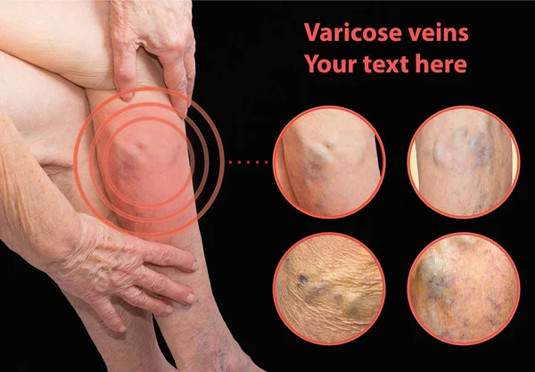 The varicose veins on a legs of old woman on gray — Stock Photo, Image