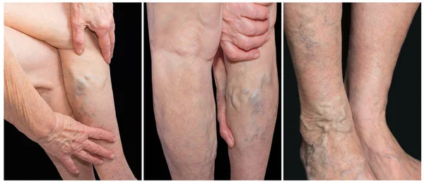 Varices douloureuses, veines d'araignée, varices sur une jambe gravement touchée. Vieillissement, maladie de vieillesse, concept de problème esthétique . — Photo