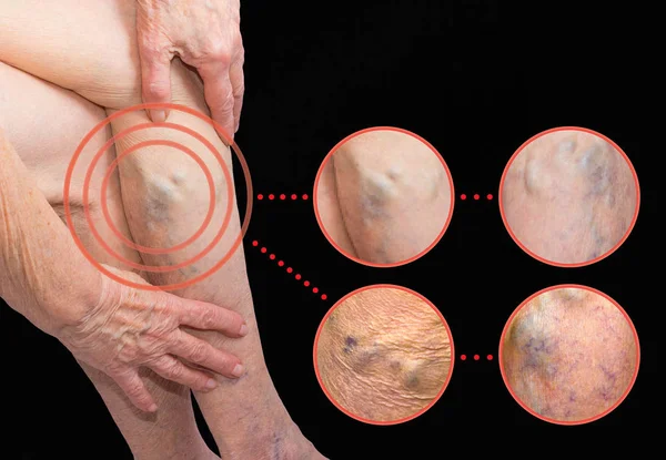 The varicose veins on a legs of old woman on gray