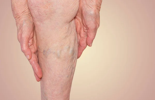The varicose veins on a legs of old woman on pastel