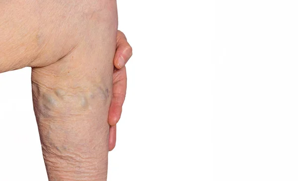 As veias varicosas em umas pernas da velha mulher no pastel — Fotografia de Stock