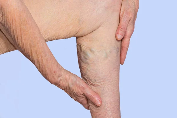 The varicose veins on a legs of old woman on pastel — Stock Photo, Image