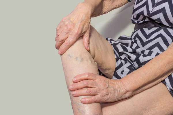 The varicose veins on a legs of old woman on pastel