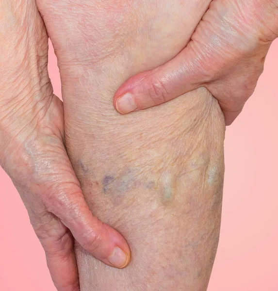 As veias varicosas em umas pernas da velha mulher no azul — Fotografia de Stock