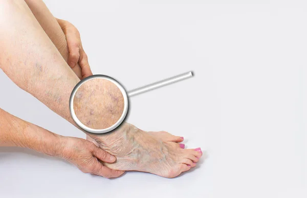 Вакцинація на ногах старої жінки на пастелі — стокове фото