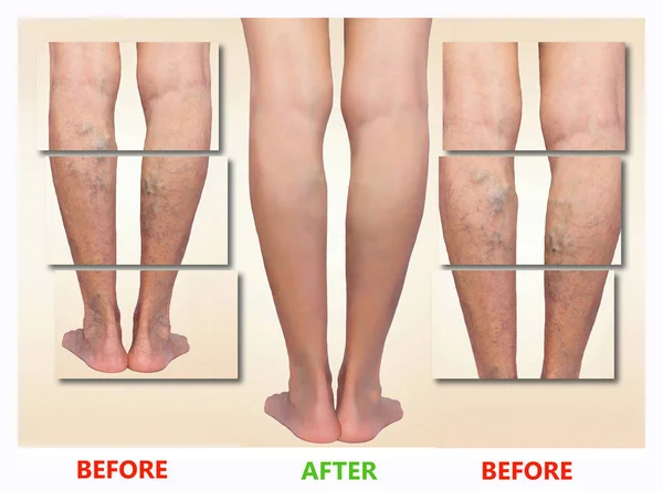 Лечение варикозного расширения до и после. Варикозные вены на ногах . — стоковое фото