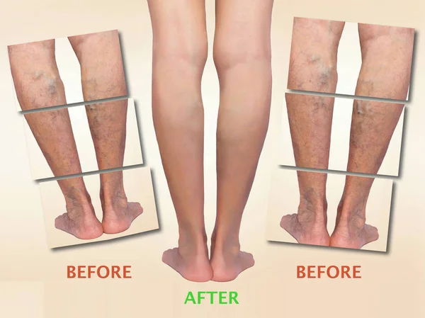 Tratamiento de la varicosa antes y después. Venas varicosas en las piernas . — Foto de Stock