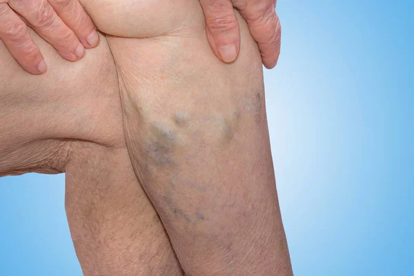 The varicose veins on a legs of old woman on blue — Stock Photo, Image