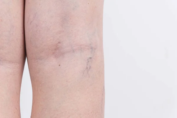 Варикозное расширение вен на ногах женщины — стоковое фото