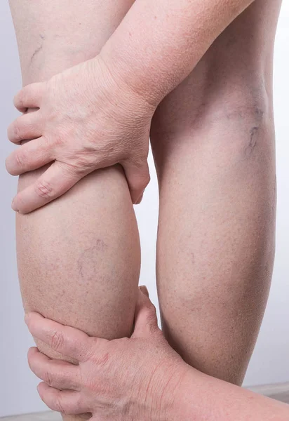 Las venas varicosas en las piernas de la mujer — Foto de Stock