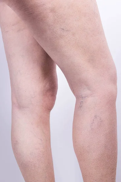 Las venas varicosas en las piernas de la mujer — Foto de Stock