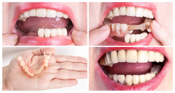 Rehabilitación dental con prótesis superior e inferior, antes y después del tratamiento —  Fotos de Stock