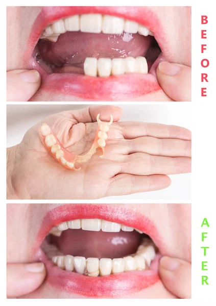 Rehabilitación dental con prótesis superior e inferior, antes y después del tratamiento —  Fotos de Stock