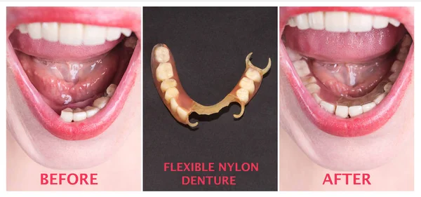 Rehabilitación dental con prótesis superior e inferior, antes y después del tratamiento —  Fotos de Stock