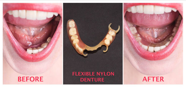 Dental rehabilitation with upper and lower prosthesis, before and after treatment