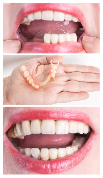 Tandheelkundige revalidatie met bovenste en onderste prothese, voor en na behandeling — Stockfoto