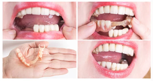 Dental rehabilitation with upper and lower prosthesis, before and after treatment — Stock Photo, Image