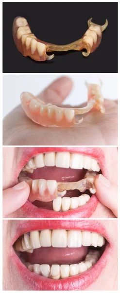 Reabilitação dentária com prótese superior e inferior, antes e após o tratamento — Fotografia de Stock