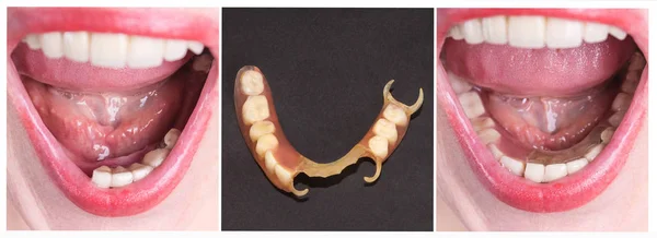 Réadaptation dentaire avec prothèse supérieure et inférieure, avant et après le traitement — Photo