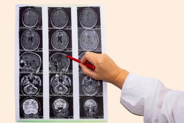 Manyetik rezonans görüntüsü veya beynin MR 'ı