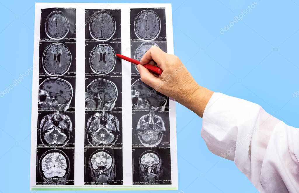 magnetic resonance image or MRI of the brain