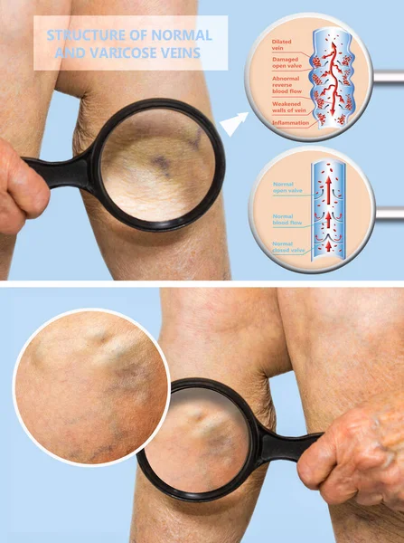 여자의 다리에 정맥류와 정맥류 정맥의 구조입니다 Thrombophlebitis 인트로 노인분들 정맥류 — 스톡 사진