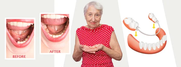 Riabilitazione Dentale Con Protesi Nylon Flessibile Inferiore Prima Dopo Trattamento — Foto Stock