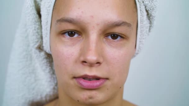 Retrato de adolescente com acne no rosto usando toalha de banho na cabeça — Vídeo de Stock