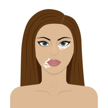 Genç bir kız vektör çizim üzerinde vitiligo belirtileri olan