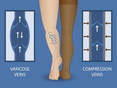 Medical compression stockings clipart