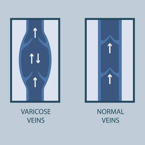 Ilustração vetorial de uma veia varicosa e veia normal . — Vetor de Stock