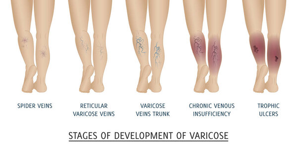 Types of varicose veins in women. 