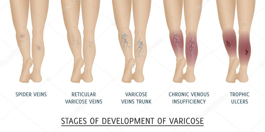 Types of varicose veins in women. 