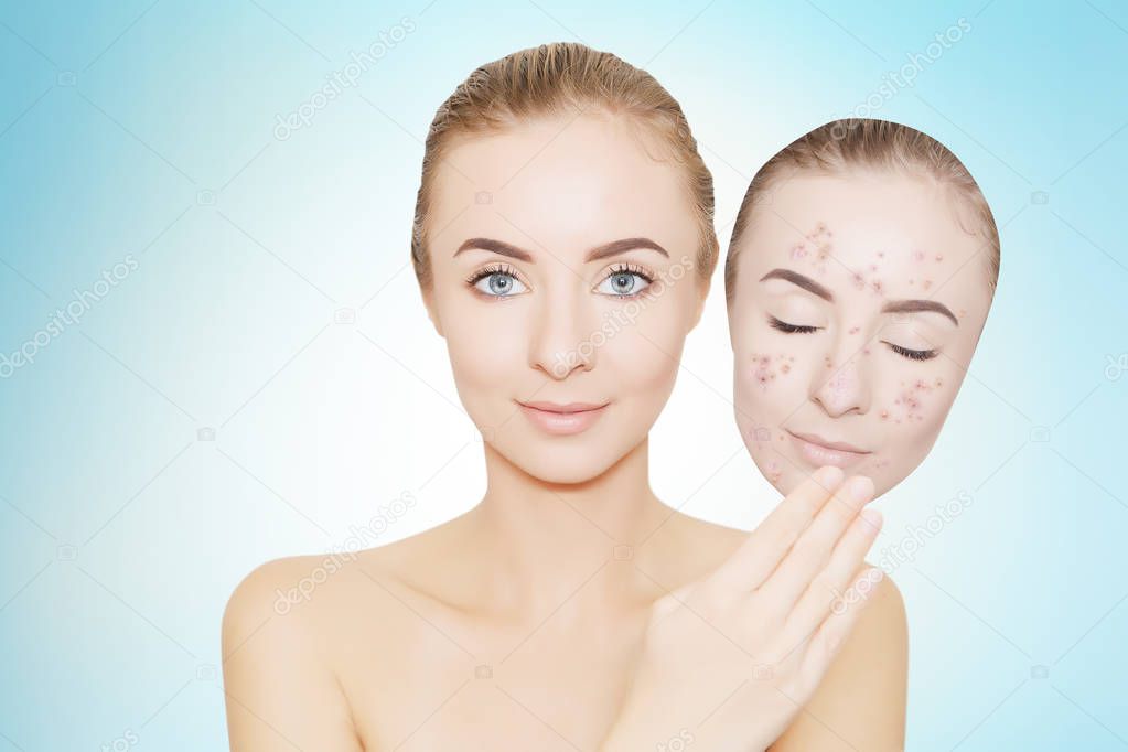 woman takes away mask with acne and pimples,blue background